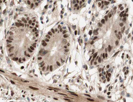 Image courtesy of Human Protein Atlasab16645 staining FOXP1 in human small intestine. Paraffin embedded human small intestine tissue was incubated with ab16645 (1/200 dilution) for 30 mins at room temperature. Antigen retrieval was performed by heat induction in citrate buffer pH 6. ab16645 was tested in a tissue microarray (TMA) containing a wide range of normal and cancer tissues as well as a cell microarray consisting of a range of commonly used, well characterised human cell lines. Further results for this antibody can be found at www.proteinatlas.org