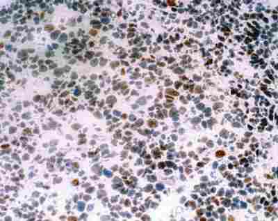 FoxP3 immunostaining on a frozen section from human tonsil. Original magnification x100. Nuclear staining was observed.