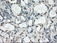 ab117951, at 1/50, staining FRA1 in paraffin-embedded Human Colon adenocarcinoma tissue by Immunohistochemistry.