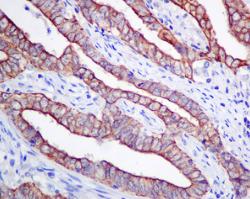 Immunohistochemical analysis of paraffin-embedded Human endometrial carcinoma tissue labeling Frizzled 8 with ab155093 at 1/50 dilution.