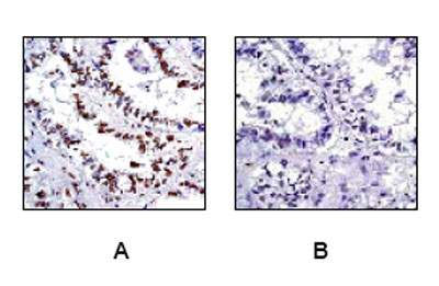 Ab32096, at a 1/250 dilution, staining CREB in paraffin embedded human thyroid gland adenocarcinoma tissue by Immunohistochemistry. Image A: Cells are untreated. Image B: Cells are treated with Phosphatase.