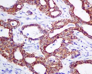 Immunohistochemical analysis of paraffin embedded Human breast carcinoma tissue using ab155093 showing +ve staining.