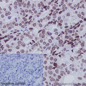Immunohistochemical analysis of paraffin embedded Human ovarian adenocarcinoma tissue labeling FUBP1 using ab192867 at a 1/2000 dilution. A prediluted HRP Polymer for Rabbit IgG was used as the secondary antibody. Hematoxylin counterstain.