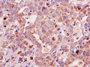 Immunohistochemical analysis of paraffin-embedded Human gastric carcinoma tissue labeling Furin with ab183495 at 1/50 dilution and counterstained with Hematoxylin.