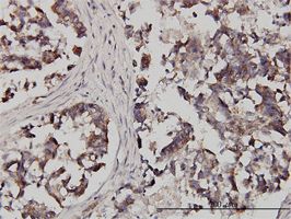 FXR1 antibody (ab56386) used in immunohistochemistry at 3ug/ml on formalin fixed and paraffin embedded human colon adenocarcinoma.