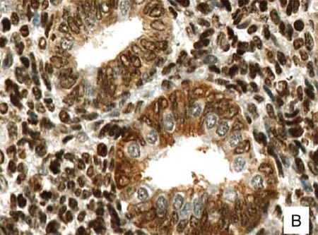 Immunohistochemical analysis of Human ovarian endometriosis tissue, staining G-protein coupled receptor 30 with ab39742 at 1/50 dilution.