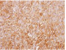 Immunohistochemical analysis of paraffin embedded Human SNU1 xenograft tissue labelling G-protein coupled receptor 30 with ab137479 antibody at 1/100 dilution.