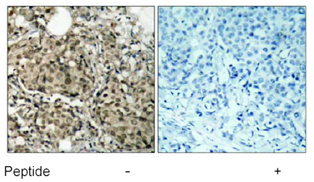 Immunohistochemical analysis of paraffin-embedded human breast carcinoma tissue using ab39533 diluted 1:50, with (right) or without (left) pre-incubation with synthetic peptide.