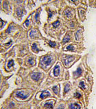 ab80403, at 1/10 dilution, staining GABA A Receptor beta 3 in human lung carcinoma by Immunohistochemistry using formalin-fixed, paraffin-embedded tissue, followed by a peroxidase-conjugated secondary antibody and DAB staining.