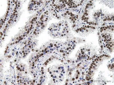 Immunohistochemical analysis of Human prostate carcinoma tissue, staining GABPA with ab55052.Tissue was fixed with formaldehyde and blocked with 1% serum for 1 hour at 21°C; antigen retrieval was by heat mediation in a Tris-EDTA buffer (pH 9). Samples were incubated with primary antibody (1/100 in PBS) for 1 hour at 21°C. A biotinylated-conjugated donkey anti-mouse polyclonal IgG (1/200) was used as the secondary antibody. See Abreview