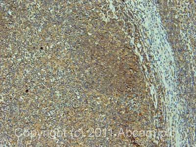 IHC image of ab10482 staining in human Hodgkin's lymphoma formalin fixed paraffin embedded tissue section, performed on a Leica BondTM system using the standard protocol F. The section was pre-treated using heat mediated antigen retrieval with sodium citrate buffer (pH6, epitope retrieval solution 1) for 20 mins. The section was then incubated with ab10482, 5µg/ml, for 15 mins at room temperature and detected using an HRP conjugated compact polymer system. DAB was used as the chromogen. The section was then counterstained with haematoxylin and mounted with DPX.For other IHC staining systems (automated and non-automated) customers should optimize variable parameters such as antigen retrieval conditions, primary antibody concentration and antibody incubation times.