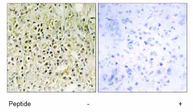 Immunohistochemistry analysis of paraffin-embedded human prostate carcinoma tissue using ab69631 at 1:50 dilution.Left image un-treated.Right image treated with immunizing peptide.