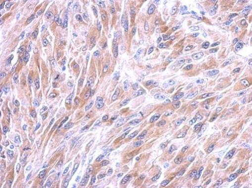 Immunohistochemical analysis of paraffin-embedded Human U87 xenograft tissue labeling Galectin 8 with ab183637 at 1/200 dilution.