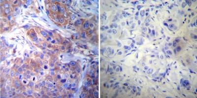 Immunohistochemical analysis of Human breast carcinoma tissue, labeling gamma Tubulin with ab173831 at a 1/20 dilution (left panel) or without primary antibody (right panel). To expose target proteins, heat induced antigen retrieval was performed using 10mM sodium citrate (pH6.0) buffer, microwaved for 8-15 minutes. Detection was performed using a biotin-conjugated secondary antibody and SA-HRP, followed by colorimetric detection using DAB. Tissues were counterstained with hematoxylin and prepped for mounting.