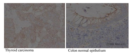 ab27074 staining gamma tubulin in human colon and thyroid tissue sections by Immunohistochemistry (Formalin/PFA-fixed paraffin-embedded sections). Tissue underwent fixation in formaldehyde, heat mediated antigen retrieval in EDTA pH 9.0 without undergoing blocking step. The primary antibody was diluted 1/1000 and incubated with sample for 1 hour at room temperature. A HRP-conjugated goat polyclonal to mouse antibody was used undiluted, as secondary.See Abreview