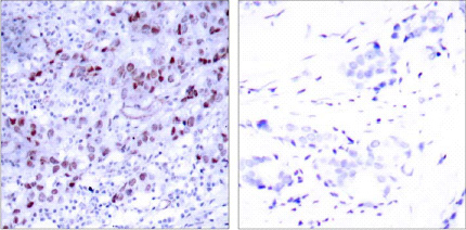 Immunohistochemical analysis of paraffin-embedded breast carcinoma. Left: Using GATA-1(Ab-1) Antibody (ab28839); Right: The same antibody preincubated with synthesized peptide.