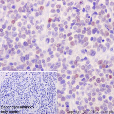Immunohistochemical analysis of paraffin-embedded Human neuroblastoma tissue labeling GATA2 + GATA3 with ab182747 at 1/500 dilution, followed by Goat Anti-Rabbit IgG H&L (HRP) (ab97051) at 1/500 dilution.Nucleus staining on cancer cells of Human neuroblastoma is observed.Counter stained with Hematoxylin. Secondary antibody only control: Used PBS instead of primary antibody, secondary antibody is Goat Anti-Rabbit IgG H&L (HRP) (ab97051) at 1/500 dilution.
