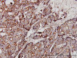 GBA antibody (ab55080) used in immunohistochemistry at 3ug/ml on formalin fixed and paraffin embedded human breast cancer.