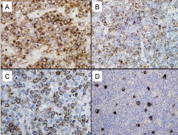 Ab68889 staining human GCET1 in Burkitt's Lymphoma (A), Follicular B Cell Lymphoma (B), Diffuse Large B Cell Lymphoma (C) and Lymphocyte Predominant Hodgkin's Lymphoma (D) by immunohistochemistry using formalin fixed, paraffin embedded tissue.