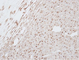 ab126167, at 1/250 dilution, staining GCSF Receptor in paraffin-embedded CL1-5 xenograft by Immunohistochemistry.