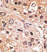 Formalin-fixed and paraffin-embedded human hepatocarcinoma tissue reacted with ab38544 at a 1/50 dilution, which was peroxidase-conjugated to the secondary antibody, followed by AEC staining. This data demonstrates the use of this antibody for immunohistochemistry; clinical relevance has not been evaluated.