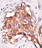 Formalin-fixed and paraffin-embedded human breast cancer tissue reacted with ab38547 at a 1/50 dilution, which was peroxidase-conjugated to the secondary antibody, followed by AEC staining. This data demonstrates the use of this antibody for immunohistochemistry; clinical relevance has not been evaluated.