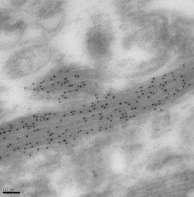 GFAP immunogold labelling TEM of corticobasal degeneration brain tissue showing heavy and highly-specific labelling over a glial process. Bar = 100 nm.This picture was kindly supplied as part of the review submitted by Dr Julian Thorpe (University of Sussex).