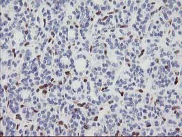 Immunohistochemical analysis of paraffin-embedded Human thyroid carcinoma tissue labelling GIMAP4 with ab131659 at 1/150 dilution.