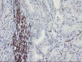 Immunohistochemical analysis of paraffin-embedded Human endometrium adenocarcinoma tissue labelling GIMAP4 with ab131659 at 1/150 dilution.