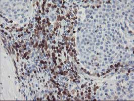Immunohistochemical analysis of paraffin-embedded Human bladder carcinoma tissue labelling GIMAP4 with ab131659 at 1/150 dilution.