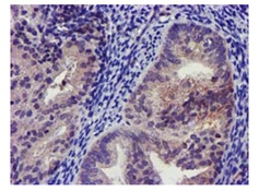 Immunohistochemical staining of paraffin-embedded Adenocarcinoma of Human endometrium tissue using ab119246 at 1/150.