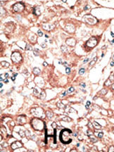 Immunohistochemical analysis of GJB2 expression in formalin-fixed and paraffin-embedded human hepatocarcinoma tissue using 1/50 ab38584.