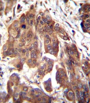 Immunohistochemical analysis of formalin-fixed, paraffin-embedded Human bladder carcinoma tissue labeling GLMN with ab170776 at 1/10 dilution, followed by peroxidase conjugation of the secondary antibody and DAB staining.