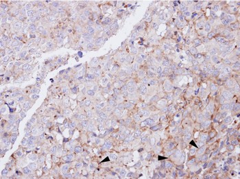 Immunohistochemical analysis of paraffin embedded CL1-0 xenograft, labelling Glucagon Receptor with ab137649 at 1/100 dilution.