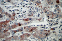 Immunohistochemical detection of GCR producing cells in formalin-fixed, paraffin embedded human breast carcinoma tissue sections with ab9568.