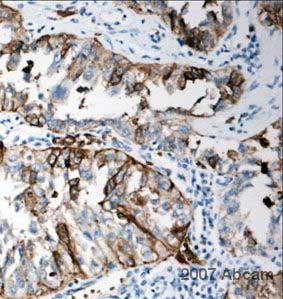 ab652 at 1/250 staining human renal carcinoma tissue sections by IHC-P. The tissue was formaldehyde fixed and a heat mediated antigen retrieval step was performed before incubation with the primary antibody for 45 minutes. An HRP conjugated goat anti-rabbit antibody was used as the secondary.See Abreview