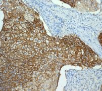 ab115730 at 1/250 dilution staining Glucose Transporter GLUT1 in Paraffin-embedded Human cervical carcinoma tissue by Immunohistochemistry.
