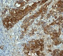 ab115730 at 1/250 dilution staining Glucose Transporter GLUT1 in Paraffin-embedded Human colonic adenocarcinoma tissue by Immunohistochemistry.