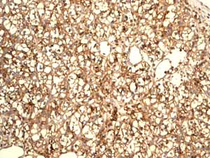 ab115730 showing positive staining in Kidney carcinoma tissue.