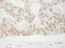 ab84984 at 1/250 dilution staining COBRA1 in human ovarian carcinoma by Immunohistochemistry, Formalin-fixed, Paraffin-embedded tissue. Detection: DAB staining.