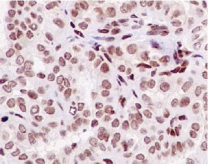 Immunohistochemical analysis of paraffin embedded Human thyroid carcinoma tissue labeling CRSP9 with ab187146 at 1/100 with prediluted (Ready to use) HRP Polymer for Rabbit IgG as secondary antibody.