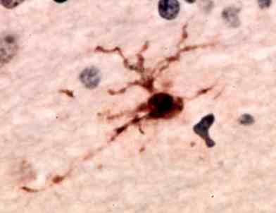 DAB staining of microglia with GPx1S in human brain tissue. Primary antibody (1/1000) secondary antibody donkey anti-sheep - biotin (1/3000) followed by Vector ABC kit. (Oil emersion).