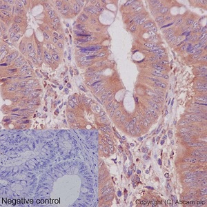 Immunohistochemical analysis of paraffin embedded human colon adenocarcinoma tissue sections labeling CRTAP using ab192261 at a 1/250 dilution. A ready to use HRP Polymer for Rabbit IgG was used as the secondary. Hematoxylin counterstain.