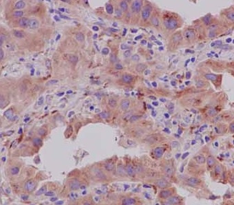 Immunohistochemical analysis of paraffin embedded Human lung adenocarcinoma tissue sections labeling CRTAP using ab183720 at a 1/500 dilution. A ready to use HRP Polymer for Rabbit IgG was used as the secondary. Hematoxylin counterstain.