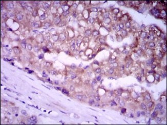ab129381 at 1/200 dilution staining Glypican 3 in paraffin-embedded Human liver cancer tissue by Immunohistochemistry, with DAB staining.