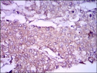 ab129381 at 1/200 dilution staining Glypican 3 in paraffin-embedded Human liver cancer tissue by Immunohistochemistry, with DAB staining.