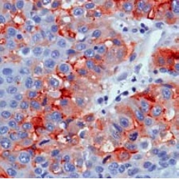 ab95363, at 1/100 dilution, staining Glypican 3 in formalin-fixed, paraffin-embedded Human liver cancer tissue by Immunohistochemistry.