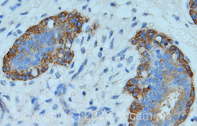 IHC image of Golgin 97 staining in human breast carcinoma FFPE section, performed on a BondTM system using the standard protocol F. The section was pre-treated using heat mediated antigen retrieval with sodium citrate buffer (pH6, epitope retrieval solution 1) for 20 mins. The section was then incubated with ab84340, 5µg/ml, for 8 mins at room temperature and detected using an HRP conjugated compact polymer system. DAB was used as the chromogen. The section was then counterstained with haematoxylin and mounted with DPX.