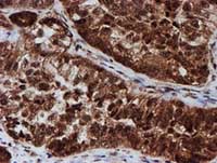 ab128534, at 1/150 dilution, staining CRYZL1 in paraffin-embedded Human ovary adenocarcinoma tissue by Immunohistochemistry.