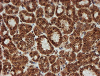 ab128534, at 1/150 dilution, staining CRYZL1 in paraffin-embedded Human thyroid carcinoma tissue by Immunohistochemistry.